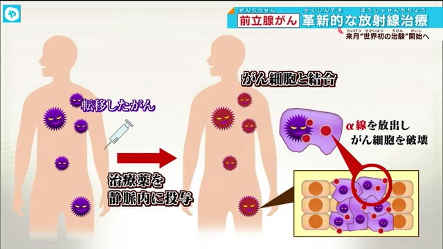 男性がかかりやすい1位「前立腺がん」 大阪大学で最新治療発表